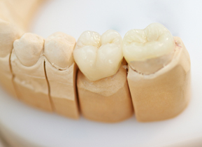 dental ceramics