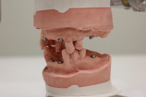 BCI Dental Implants